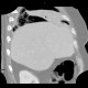 Lobar pneumonia: CT - Computed tomography