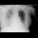 Pneumonia: X-ray - Plain radiograph