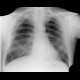 Pneumonia, lobar pneumonia: X-ray - Plain radiograph