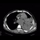 Pneumonia, lobar pneumonia: CT - Computed tomography