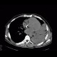 Pneumonia, lobar pneumonia: CT - Computed tomography