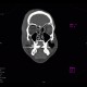 Pneumoorbita: CT - Computed tomography