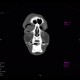 Pneumoorbita: CT - Computed tomography