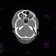 Pneumoorbita: CT - Computed tomography