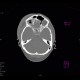 Pneumoorbita: CT - Computed tomography