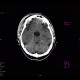 Pneumoorbita: CT - Computed tomography