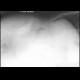 Pneumoperitoneum, lateral radiograph: X-ray - Plain radiograph