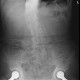 Pneumoperitoneum: X-ray - Plain radiograph