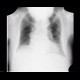 Pneumoperitoneum: X-ray - Plain radiograph