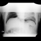 Pneumoperitonum after EPE, endoscopic polypectomy, complication, hemoclips: X-ray - Plain radiograph
