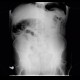 Pneumoperitonum after EPE, endoscopic polypectomy, complication, hemoclips: X-ray - Plain radiograph
