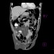 Pneumoretroperitoneum, pneumomediastinum, complication of colonoscopy: CT - Computed tomography