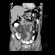 Pneumoretroperitoneum, pneumomediastinum, complication of colonoscopy: CT - Computed tomography