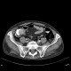 Pneumoretroperitoneum, pneumomediastinum, complication of colonoscopy: CT - Computed tomography