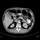 Pneumoretroperitoneum, pneumomediastinum, complication of colonoscopy: CT - Computed tomography