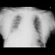 Pneumothorax, supine radiograph: X-ray - Plain radiograph