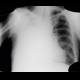 Pneumothorax, fluidopneumothorax, pleural drainage: X-ray - Plain radiograph
