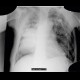 Pneumothorax, fluidopneumothorax, pleural drainage: X-ray - Plain radiograph
