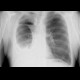 Lobectomy, residual cavity: X-ray - Plain radiograph