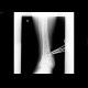 Cut wound of tibia, friction saw: X-ray - Plain radiograph