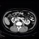 Horseshoe kidney: CT - Computed tomography