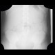 Subcutaneous emphysema after operation of hernia: X-ray - Plain radiograph