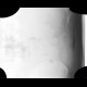 Subcutaneous emphysema after operation of hernia: X-ray - Plain radiograph