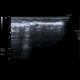 Subcutaneous emphysema after operation of hernia: US - Ultrasound