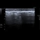 Subcutaneous emphysema after operation of hernia: US - Ultrasound
