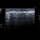 Subcutaneous emphysema after operation of hernia: US - Ultrasound