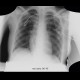 Circulatory assist device: X-ray - Plain radiograph