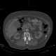 Osteopoikilosis, systemic bone disorder: CT - Computed tomography