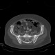 Osteopoikilosis, systemic bone disorder: CT - Computed tomography