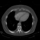 Osteopoikilosis, systemic bone disorder: CT - Computed tomography