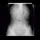 Foreign body in the gut: X-ray - Plain radiograph