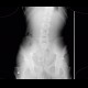 Foreign body in the gut: X-ray - Plain radiograph