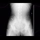 Foreign body in the gut: X-ray - Plain radiograph