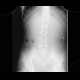 Foreign body in the gut: X-ray - Plain radiograph