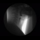 Videofluoroscopic swallow study: RF - Fluoroscopy