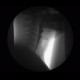 Videofluoroscopic swallow study: RF - Fluoroscopy