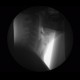 Videofluoroscopic swallow study: RF - Fluoroscopy