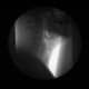 Videofluoroscopic swallow study: RF - Fluoroscopy