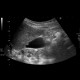 Polyp of gall bladder: US - Ultrasound