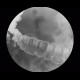 Polyp of transverse colon, barium enema: RF - Fluoroscopy