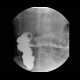 Polyp of transverse colon, barium enema: RF - Fluoroscopy