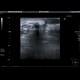 Lymphedema and seroma of the breast, postoperatively: US - Ultrasound