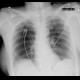 Pneumoperitoneum, postoperative, supine chest radiograph: X-ray - Plain radiograph