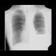 Postoperative pneumoperitoneum: X-ray - Plain radiograph