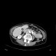 Porcelain gall bladder: CT - Computed tomography