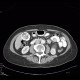 Porcelain gallbladder, calcification of gallbladder, cholecystolithiasis, gallstones: CT - Computed tomography